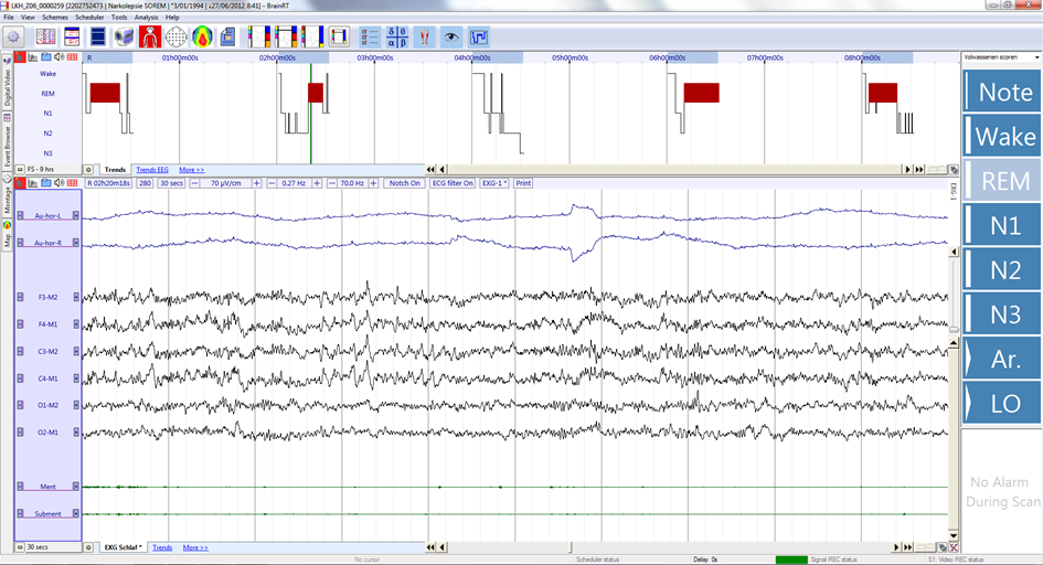 Example of MSLT recording of a narcolepsy patient. The patient is free to move around at times between tests and data are usually not stored at these times. The resulting acquisition consists of 5 separate recordings. 