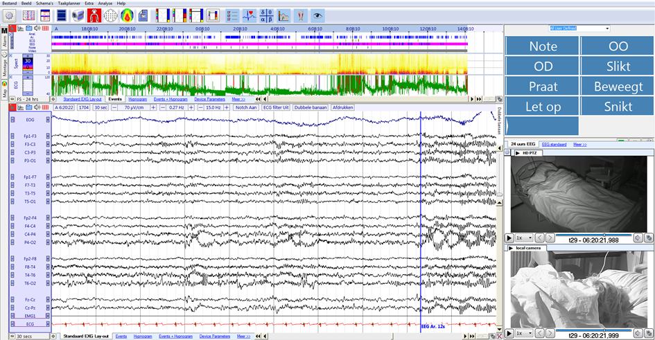 SleepRT™ example of sleep epilepsy acquisition with 10/20 EEG recording, respiratory effort bands, EOG, EMG and ECG. The recording includes two HD cameras for optimal recording of the patient's actions.